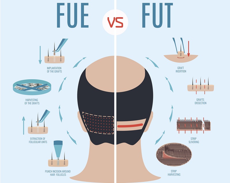 FUE vs. FUT Hair Transplants
